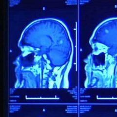 Umetna inteligenca lahko napove nastanek Alzheimerjeve bolezni